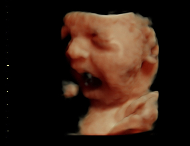 3D ultrasound image at 31 weeks